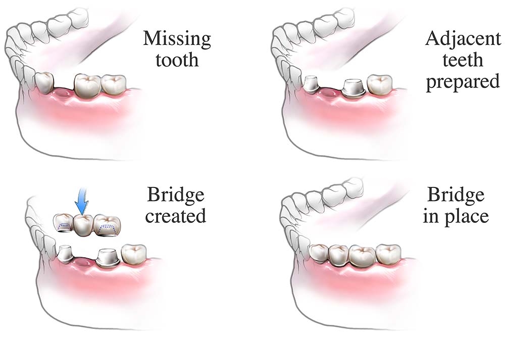 dental bridge