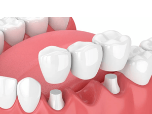 Dental Bridge