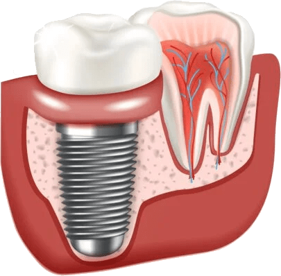 Dental Implants