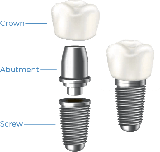 Dental Implants