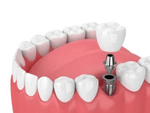 Dental Implants