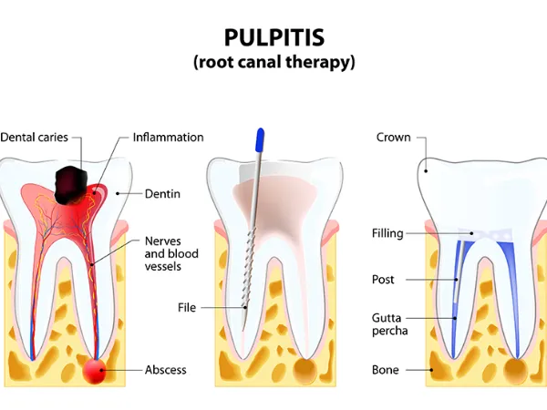 Root Canal Treatment