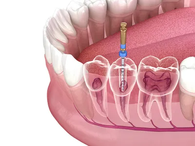 Root Canal Treatment