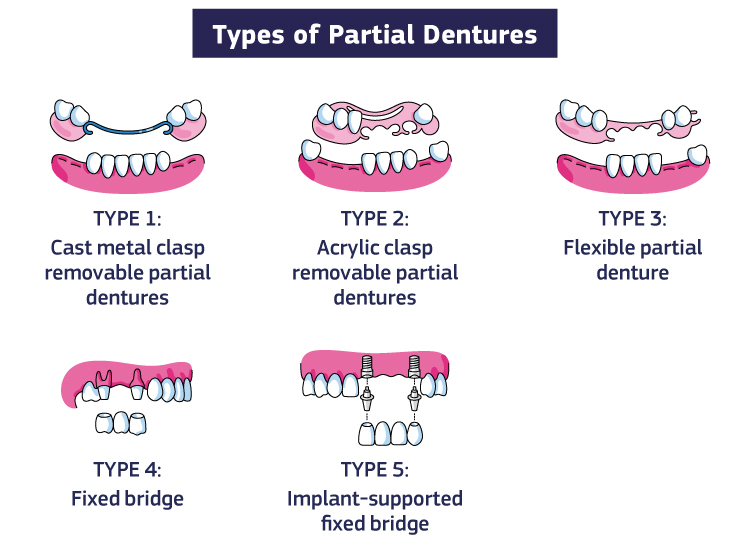 Dentures (normal and flexible, monoplast.)