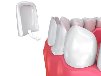 Dental Veneers