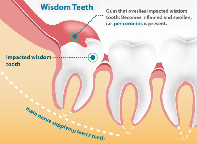 Wisdom Tooth Extraction