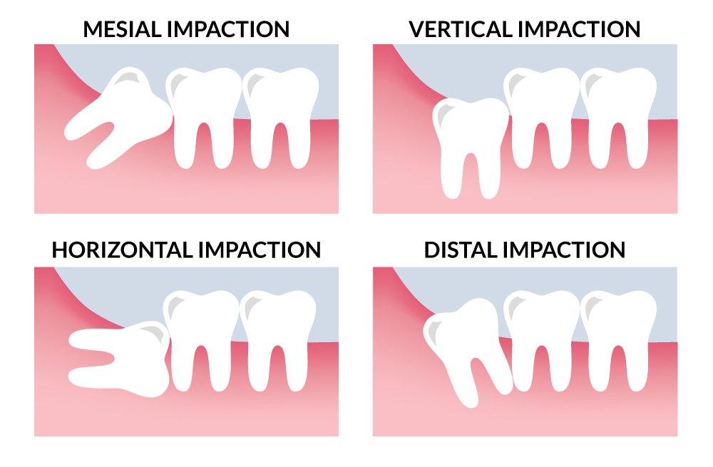 Wisdom Tooth Extraction